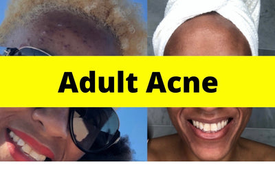 Using Like It On Top for Adult Acne