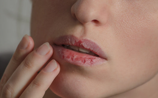 Let's talk about dry lips and winter skincare!