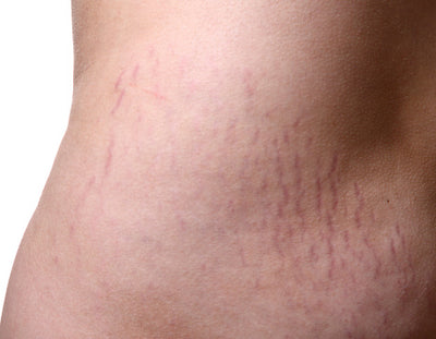What are stretch marks & how to fade them naturally?