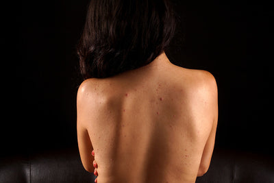 How to fade dark marks & dark spots on the body naturally