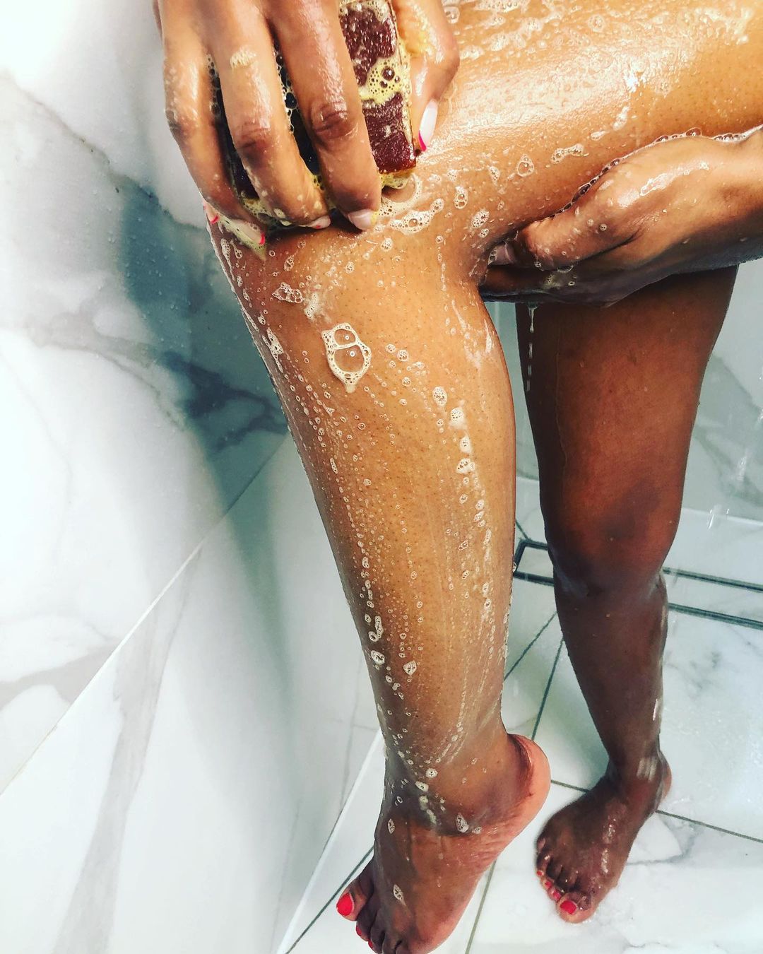 Dark Marks / Stretch Marks (Body)