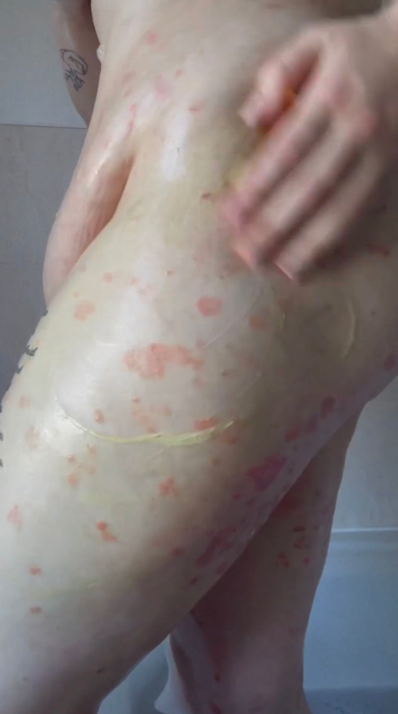 Eczema / Psoriasis (Body)